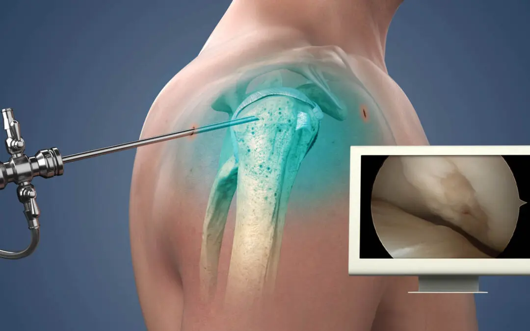 Shoulder Challenge 2026