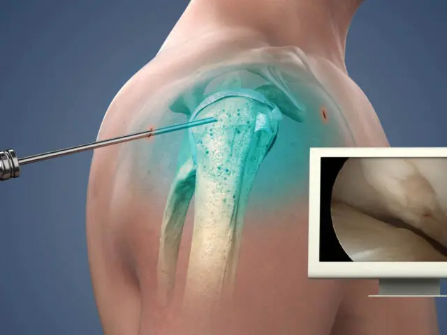 Shoulder Challenge 2026