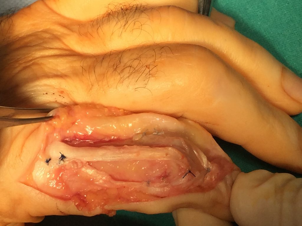 Lesiones de tendones de la mano